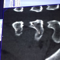 ファビアン・カンチェラーラ（トレックファクトリーレーシング）、脊椎骨横突起骨折のスキャン画像